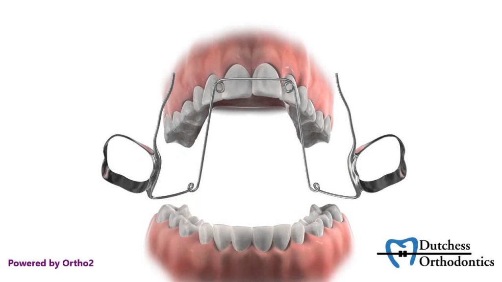 quad_helix_3D Orthodontiste Le Mans